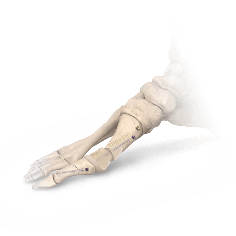 Bone model showing completed surgery and two-screw solution.