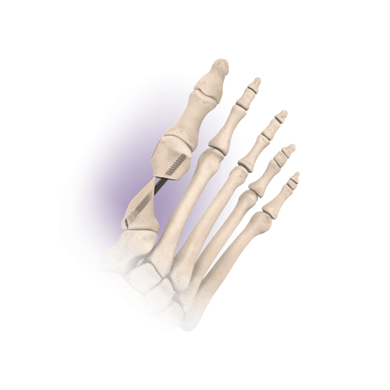 Superior bone view showing Revcon™ Anchor single screw solution.