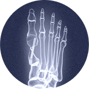 X-ray showing a fixed bunion.